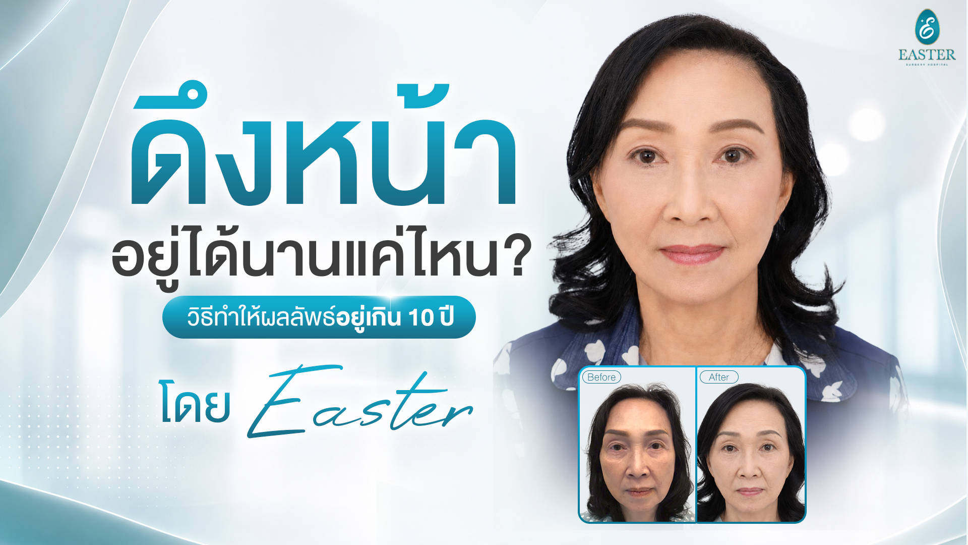 拉皮手术能维持多久？ - 伊斯特整形医院